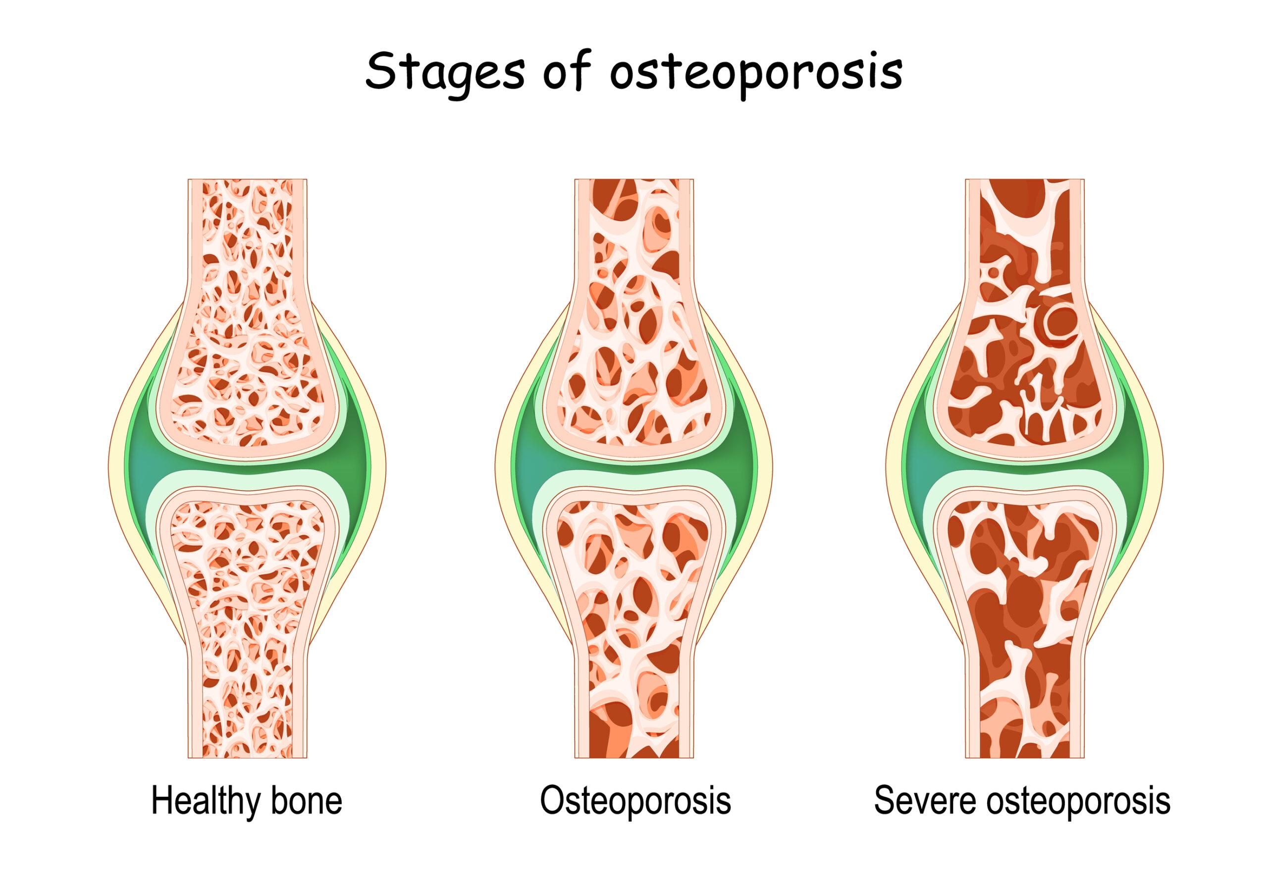Stages of osteoporosis